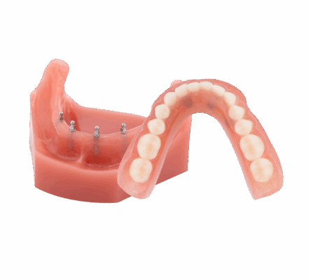 Same-Day Dentures in Springfield, MO | Snap-In Dentures