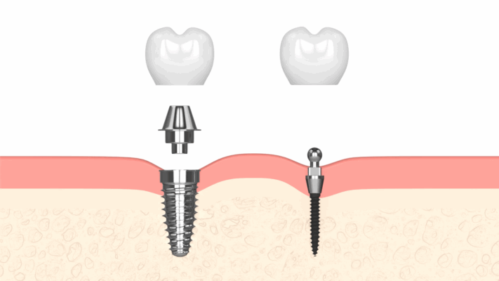 Dental Implants in Springfield, MO | Book a FREE Consultation