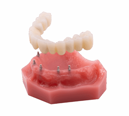 Fixed Implant Dentures in Springfield, MO | Free Consultations!