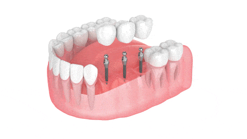 Dental Bridge in Springfield, MO | Mini Implant-Supported Bridges