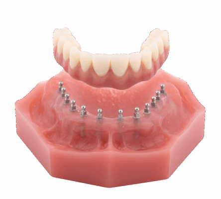 Dentures in Springfield, MO | Non-Removable Roundhouse Bridge