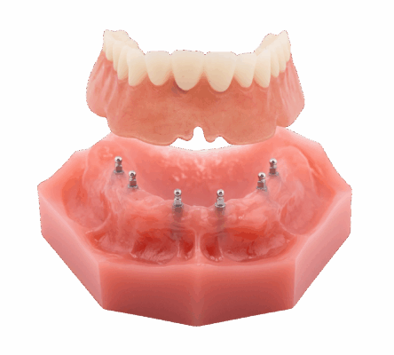 Removable Implant Dentures in Springfield, MO | Free Consultation