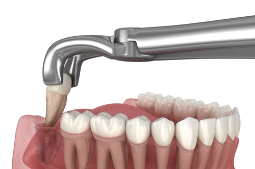 Tooth Extraction in Springfield, MO | Free Implant Consultations