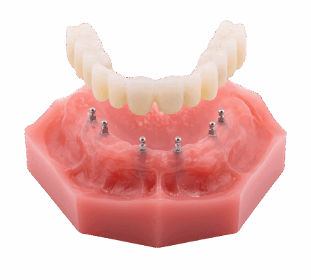 Full-Arch Dental Implants in Springfield, MO | Free Consultations