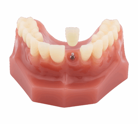 Dental Crown in Springfield, MO | Dental Implants for Missing Teeth