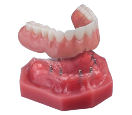 Denture Stabilization in Springfield, MO | Snap-On Denture Solutions