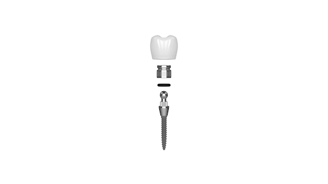 Dental Implants Cost in Springfield, MO | The Mini Implant Difference
