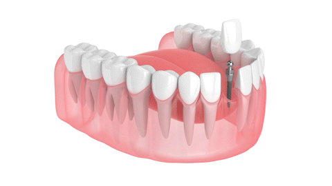 Same-Day Dental Implants in Springfield, MO | Restore Your Smile