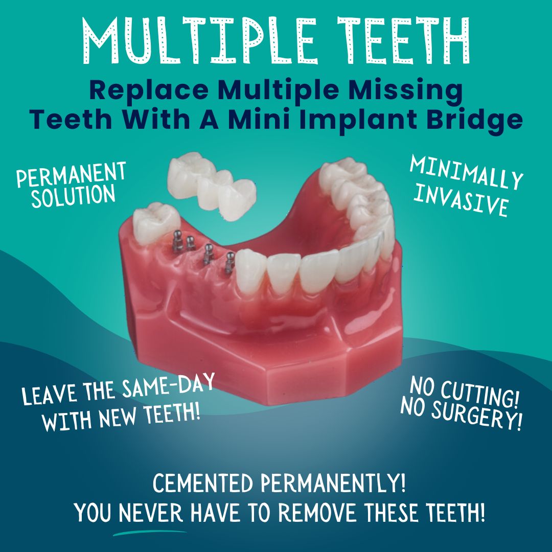 Multiple Teeth Replacement in Springfield, MO