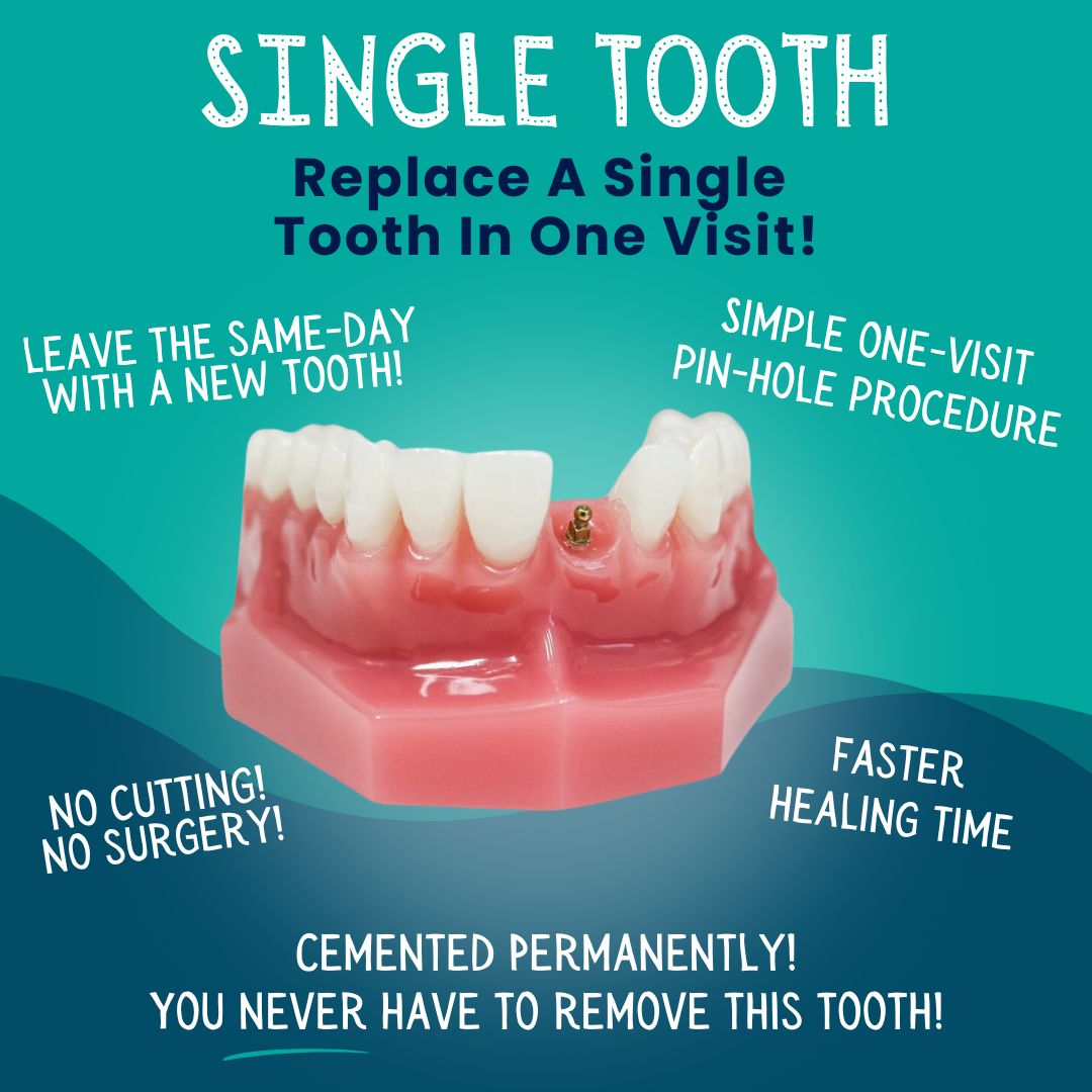 Single Tooth Replacement in Springfield, MO