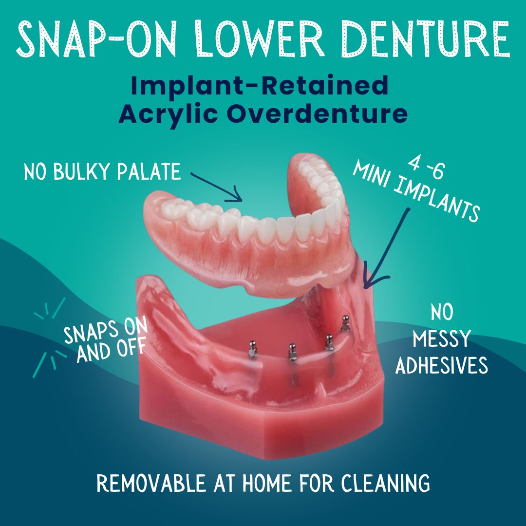 Snap-On Lower Denture in Springfield, MO