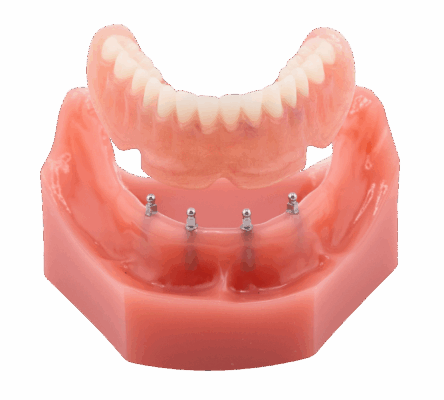 Floating Dentures in Springfield, MO | Free Implant Consultations