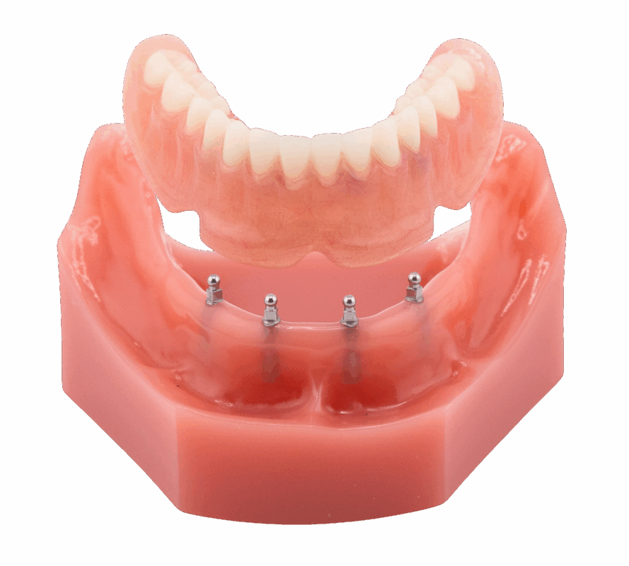 Floating Dentures in Springfield, MO | Free Implant Consultations