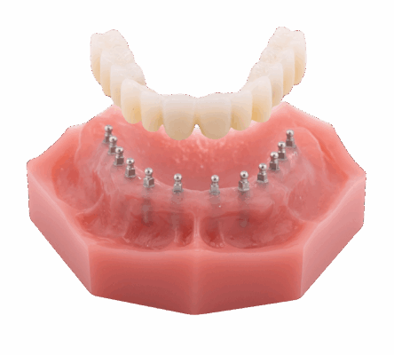 Roundhouse Bridge in Springfield, MO | Permanent Solutions to Tooth Loss