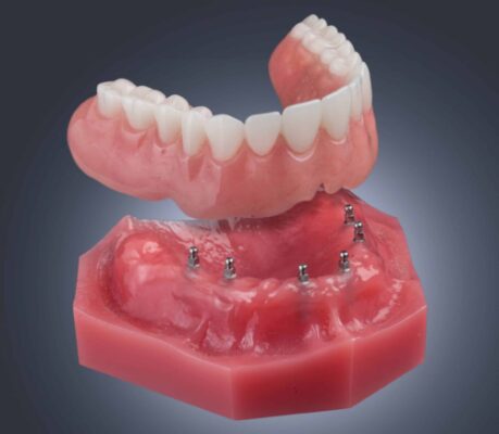 Snap-On Dentures in Springfield, MO | Stabilize Your Smile With Mini Implants