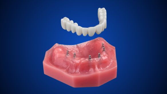 Which Denture Is Best for Eating | Find Affordable Implant Dentures in Springfield, MO