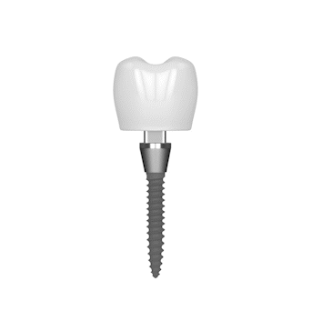 Not Enough Bone for Implants? | Free Consults in Springfield, MO