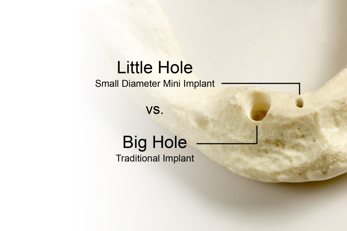 What Is Considered a Mini Dental Implant? | Free Implant Consultations in Springfield, MO