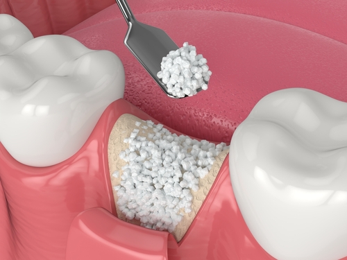 Bone Graft for Implants in Springfield, MO | Free Consultations