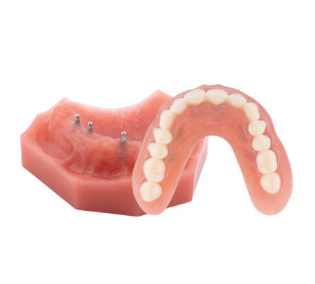 All-on-Four Alternatives in Springfield, MO | Free Implant Consults