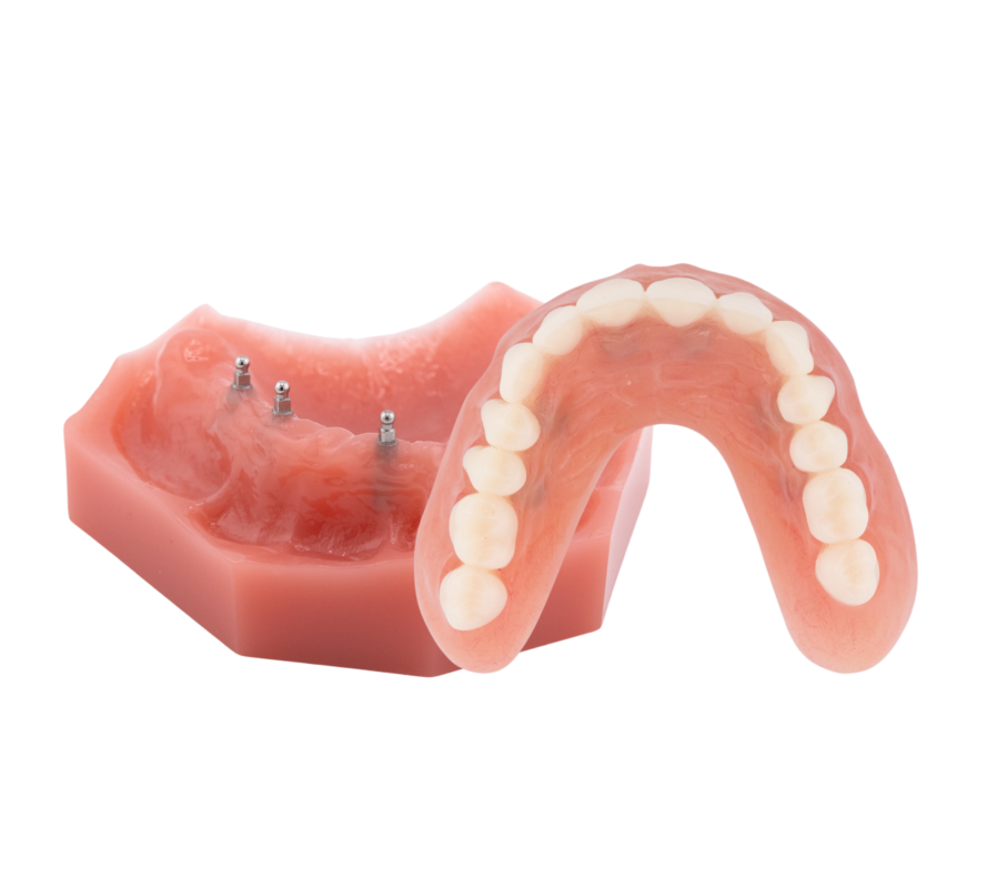 All-on-Four Alternatives in Springfield, MO | Free Implant Consults