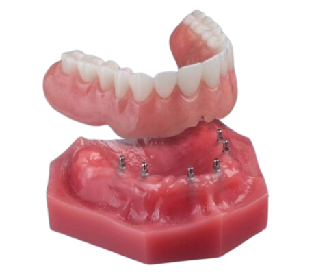 Snap-In Dentures in Springfield, MO [Video Demo] | Free Consults