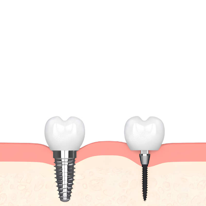 Best Implant Options in 2026 [Video Explanation] Free Consultation