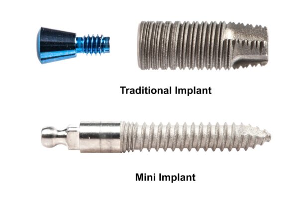 One-Piece Dental Implants [Video Q&A] | Book a Free Consultation
