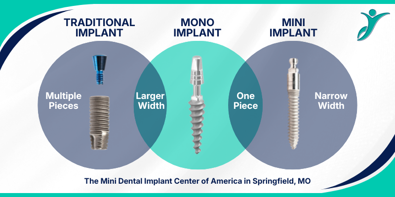 Permanent Dentures in Springfield, MO | Mini vs. Mono Dental Implants