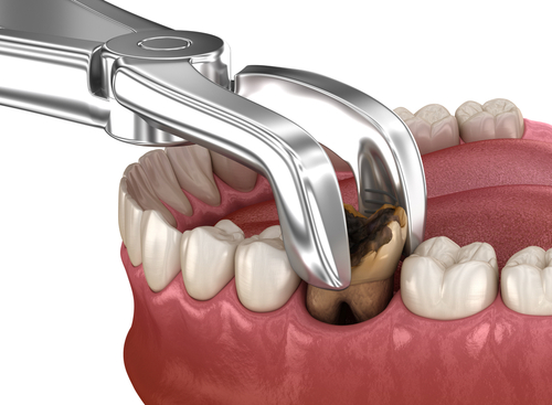Tooth Extraction Cost [Video FAQs] | Affordable Care in Springfield