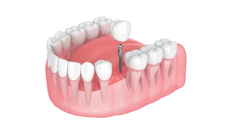 Dental Implants in Willard, MO | Use Minimally Invasive Dental Implants To Restore Your Smile