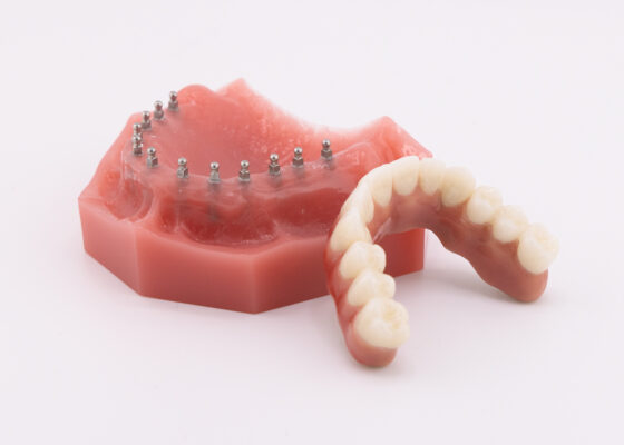 Full Arch Dental Implants in Springfield, MO | Free Consultations