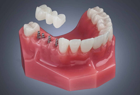 Implant Bridge in Springfield, MO | Book a Free Consultation