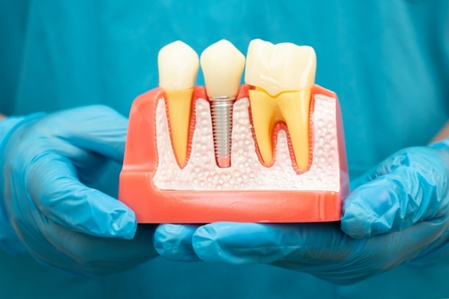 Dental Implants in Marshfield, MO | Free Consultations Near Me