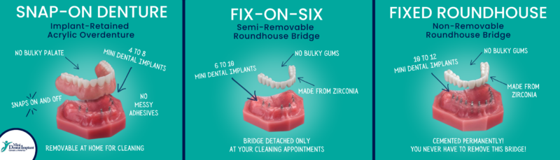 Fixed Teeth in Springfield, MO | Implant Denture Options | Book a Free Implant Consultation!