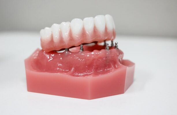 Full Mouth Dental Implants in Springfield, MO | Free Consultations